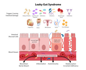 Leaky-Gut-Syndrome (1)